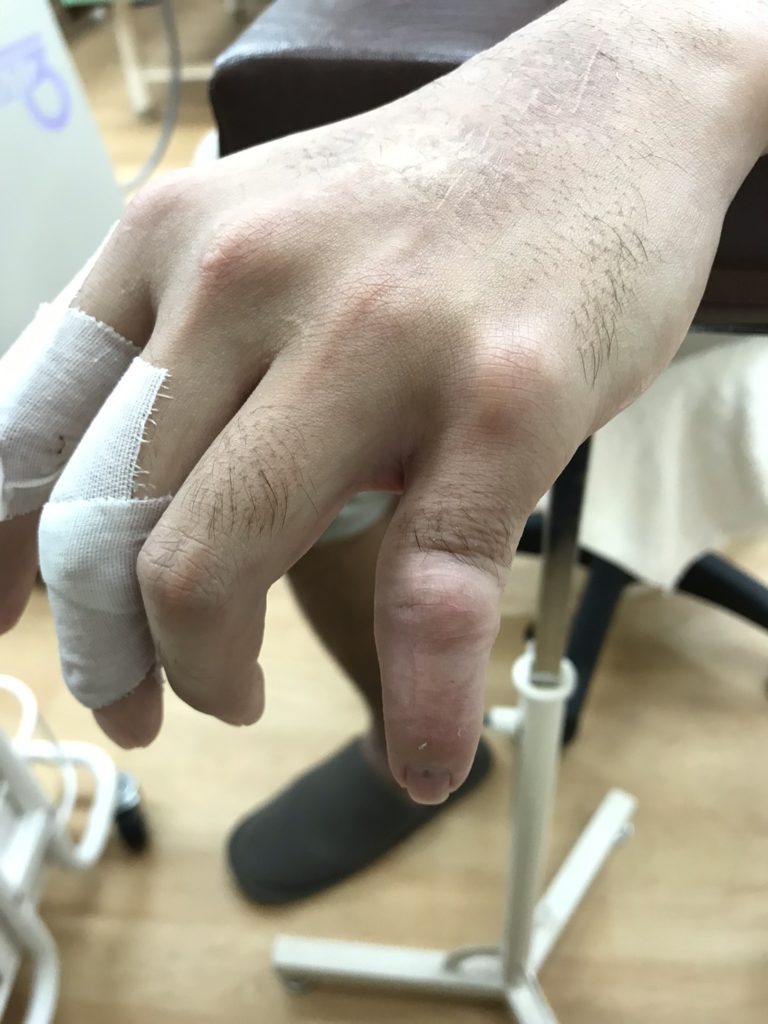 左第5指pip関節背側 側方脱臼 こばやし接骨整骨院グループ