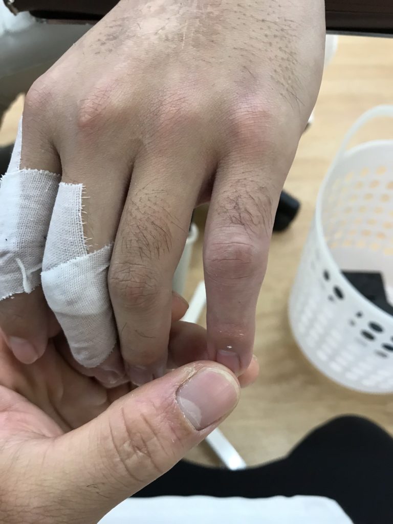 左第5指pip関節背側 側方脱臼 こばやし接骨整骨院グループ