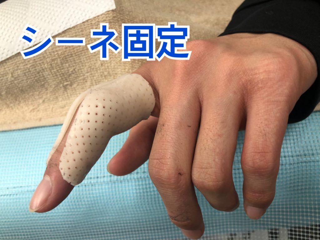 左第5指pip関節背側 側方脱臼 こばやし接骨整骨院グループ